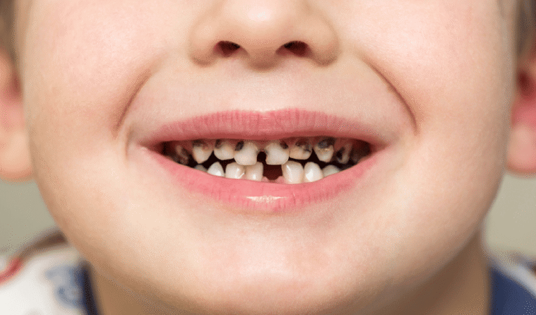 How Sugar Affects Your Child’s Teeth