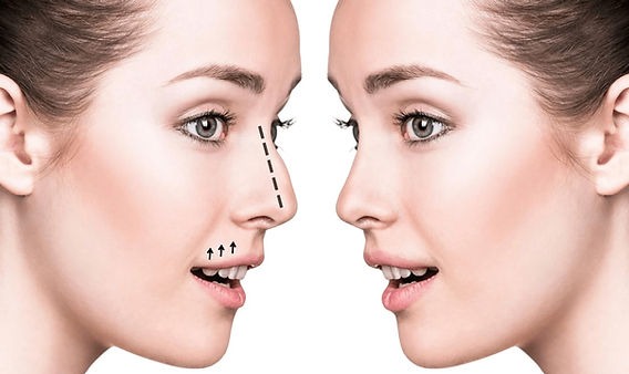 Is Rhinoplasty in Dubai the Right Choice for You?