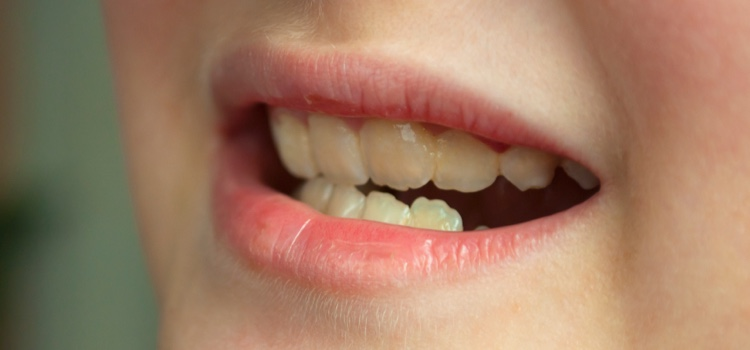 Can Thumb Sucking or Pacifiers Damage Teeth?